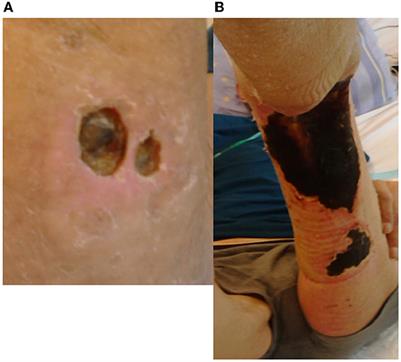 Cutaneous tuberculosis—ambiguous transmission, bacterial diversity with biofilm formation in humoral abnormality: case report illustration